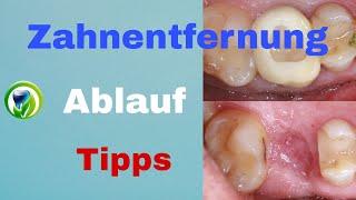 Zahnentfernung - Zahnextraktion - Zahn muss raus | Schritt für Schritt Anleitung, praktische Tipps