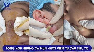 ĐIỀU TRỊ NHỮNG CA MỤN VIÊM TỤ CẦU - ÁP XE SIÊU TO KHỔNG LỔ TẠI PHÒNG KHÁM DA LIỄU HHV CLINIC