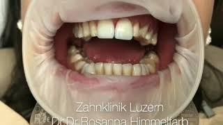 6 Veneers Smilemakeover by Zahnklinik Luzern Dr.Dr.Rosanna Himmelfarb