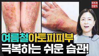 아토피가 여름에 더 심해지는 이유!? 아토피피부염 환자들이 모르는 여름철 관리법5가지 | #아토피피부염 #아토피치료 #아토피가려움