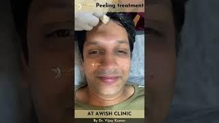 Groom facial peel before wedding | Best facial for wedding #wedding #facial #groom #peels #shorts