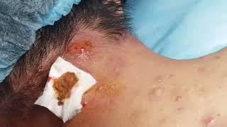 Extract Acne in Nape | HHV Clinic