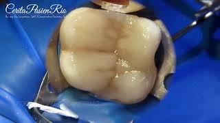 endodontic and restorative treatment on maxillary molar (dokter gigi spesialis konservasi gigi)