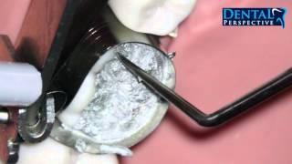 Amalgam Carving HD - Dental Perspective