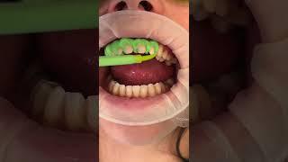 CAVITIES & VENEERS??? # #cosmeticdentistry #dental #veneers #dentist #dental