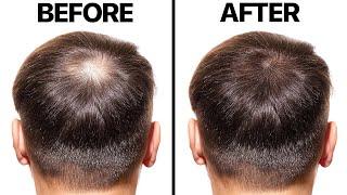 Minoxidil for Hair Loss