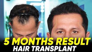 Hair Transplant in Bangalore | Best Results & Cost of Hair Transplant in Bangalore