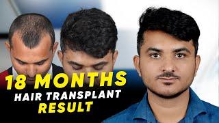 Hair Transplant in Anantapur | Best Results & Cost of Hair Transplant in Anantapur