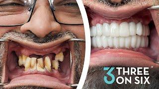 3 on 6 - Alternative to All-on-4 and Implant Dentures