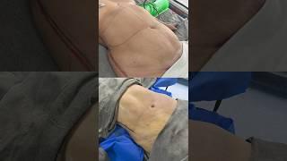 Abdomen Liposuction: Before and After Results | Divine Aesthetics #ytubeshorts