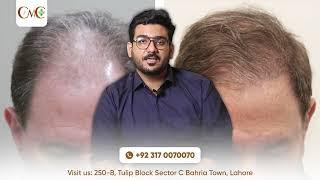 Hair Loss Treatment, Balon K Girnay Ka Ilaj! | By Cureall Medical Centre