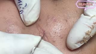 ALin Spa(55)_Mụn Acnes