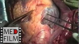 Сoronary artery bypass grafting with endarterectomy ©