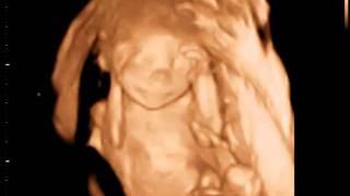 3D Ultrasound Coquitlam | 3D Sono Image