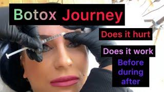 First time BOTOX what to expect, did it work ? Does it hurt? full journey botox Before and after