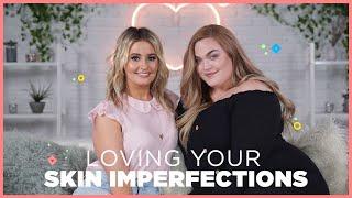 Loey Lane on Loving Your Imperfect Skin