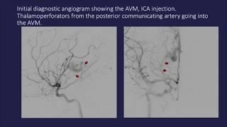 Transvenous embolization of thalamic arteriovenous malformation under transient cardiac standstill