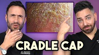 How to Treat Cradle Cap like a Dermatologist | Doctorly Dads