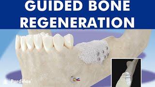 Guided bone regeneration - Bone graft ©