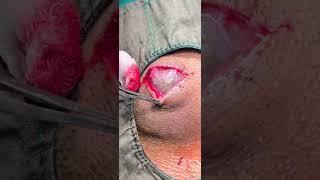 Sebaceous cyst cheeck excision - Dr Hitesh Patel