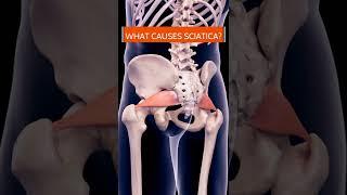 What Is Piriformis Syndrome? What Does It Feel Like?