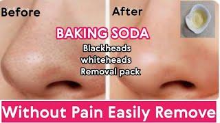 Blackheads Whiteheads Removal Pack | Easily Remove At Home | Homeremedies | Nida Naseer