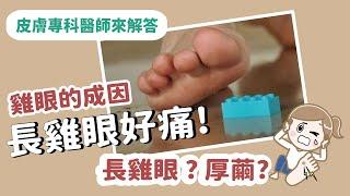 【皮膚專科醫師來解答】雞眼是如何形成的? 雞眼的成因，日常生活中那些習慣會造成雞眼?