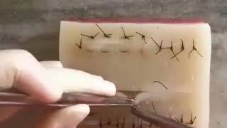 How to do Horizontal mattress suture