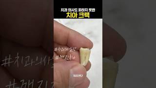 ‍️치과 의사도 피하지 못한 치아 크랙