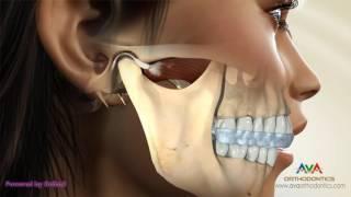 TMJ Occlusal Splint