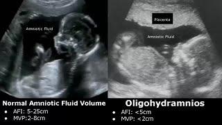 Obstetric Ultrasound Normal Vs Abnormal Images | Fetal, Placenta, Umbilical Cord Pathologies USG