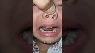 Something Stuck In Nose   | How Doctor Remove It |        #shorts