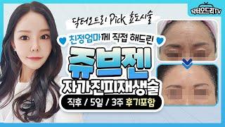 쥬브젠 자가진피재생술 : 깊은 주름을 한번의 시술로 반영구적으로 없앨수 있다? 직접 눈으로 확인해보세요!