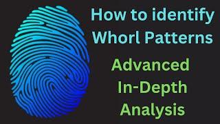 How to identify Whorl Patterns in DMIT Report Generation Software | Advanced In-Depth Analysis