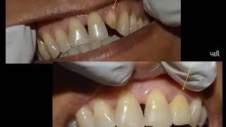 Single tooth root canal treatment | Metal Ceramic Crown | Dental treatment | Affordable