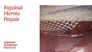 LAP Inguinal Hernia Repair TAPP with ULTRAPRO ADVANCED™ Mesh & STRATAFIX™ Spiral (Dr. Steven Leeds)