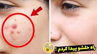 چگونه جوش های صورت را در دو دقیقه از بین ببریم؟ 