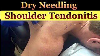 Dry Needling for Shoulder and Lower Neck Pain