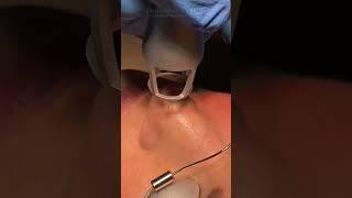 Laser Mole Removal - Teaser