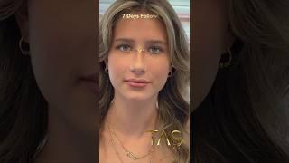 Charming beauty TAS Nose Crown  after nose job by Prof.Dr.Suleyman Tas