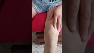 Варикоз излечим !                     https://dandelion-marat.tilda.ws/