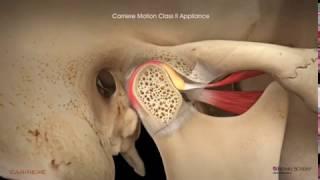 Carriere® Motion Clear™ Appliance with Clear Aligners Patient Education Animation