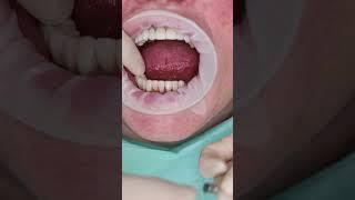 Dental implant’s in Prague #shorts #dentist #dental #implant #veneers #short