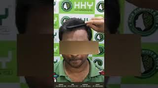 Hair transplant cost in Guwahati, #hairtransplant