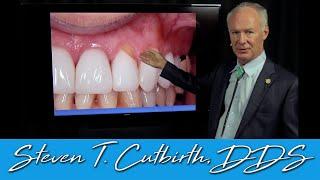 Abfraction on Tooth Colored Restorations - Dental Minute with Steven T. Cutbirth, DDS