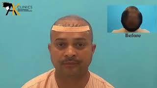 Hair Transplant Result at AK Clinics by Dr. Kapil Dua