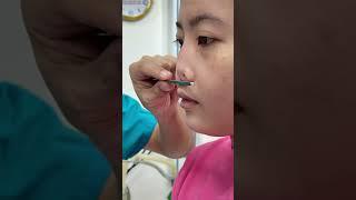 Rhinoplasty By Dr Nguyen Tien Huy #saigonvenusclinic #bacsinguyentienhuy#rhinoplasty#fyp#glowup