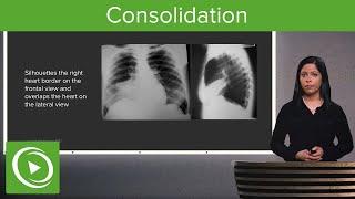 Consolidation – Radiology | Lecturio