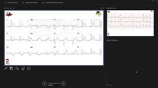 Langenthaler Ekg Shots, STEMI Equivalents, Teil 3