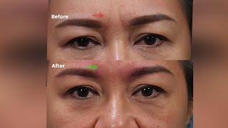 How to treat permanent wrinkles